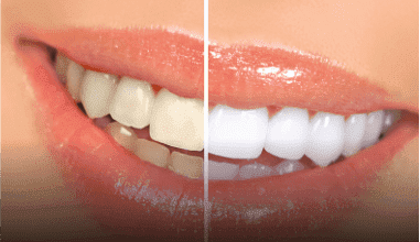 Teeth Whitening