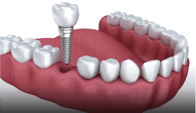 Dental Implants