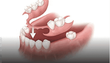 Partials Dentures